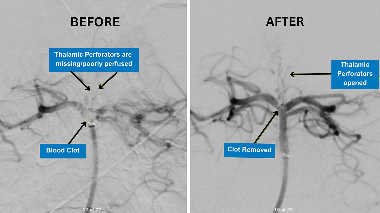 A before and after image showing Alfin's clot being removed.